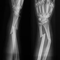 PainfulRecovery